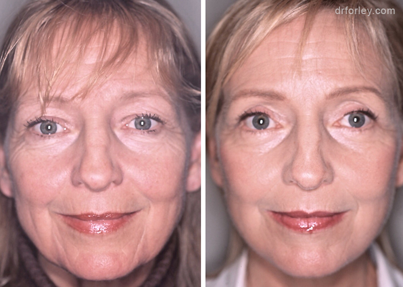 Woman's face Before and After Facelift treatment, front view, patient 1