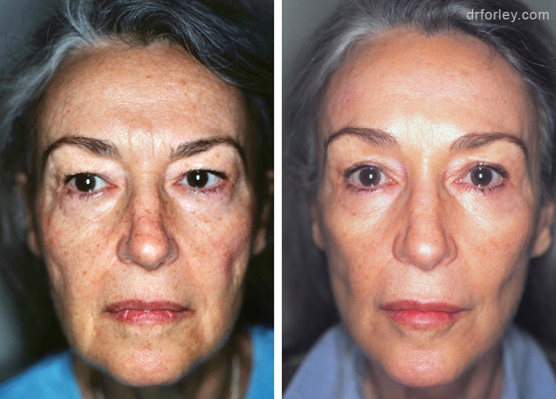 Woman's face Before and After Facelift treatment, front view, patient 4