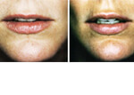Female lips, before and after Injectable Fillers treatment, front view, patient 4