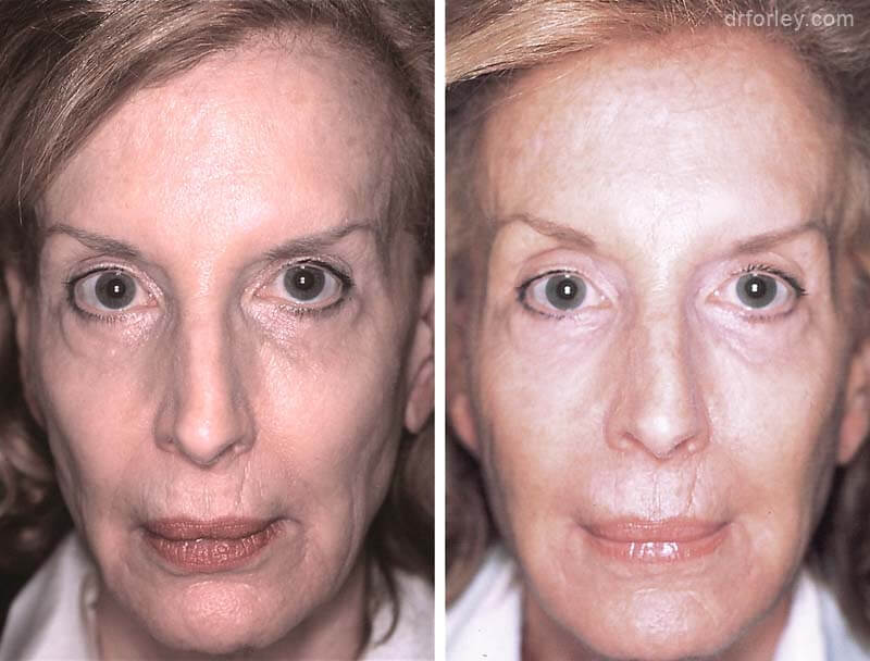 Female face, before and after Injectable Fillers treatment, front view, patient 5