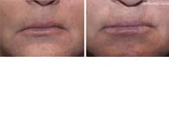 Female lips, before and after Injectable Fillers treatment, front view, patient 6