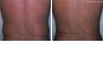 Patient back, before and after liposuction treatment, back view, patient 2