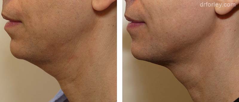 Male neck, before and after Ultherapy treatment, side view, patient 9