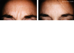 Female forehead, before and after Neuromodulator treatment, front view - patient 1