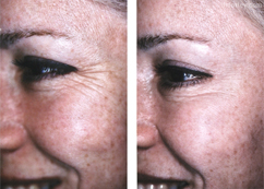 Female forehead, before and after Neuromodulator treatment, oblique view - patient 2