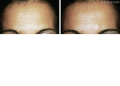Female forehead, before and after Neuromodulator treatment, front view - patient 3