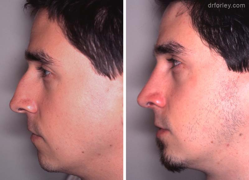 Male face, before and after rhinoplasty, nose l-side view, patient 3