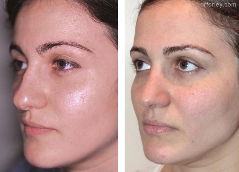 Female face, before and after rhinoplasty, nose l-side oblique view, patient 4