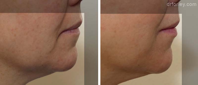 Woman’s face, before and after Silhouette InstaLift treatment, side view, patient 14