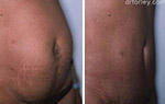 Female body, TUMMY TUCK, Before and After treatment photo, oblique view, patient 2