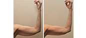 Woman’s arms, before and after BodyTite treatment, front view, patient 15