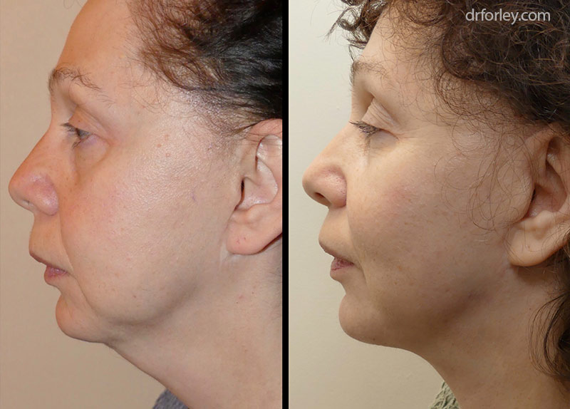 Before & After Facelift Set2 thumb1