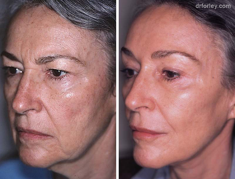Facelift Photo: Woman's face After Treatment, oblique left view, patient 1