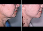 Woman's face Before and After Facelift treatment, right side view, patient 5