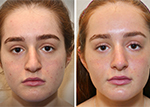 Female face, before and after rhinoplasty, front view, patient 5