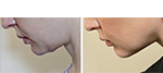 Female face, before and after NeckTite treatment, side view, patient 5