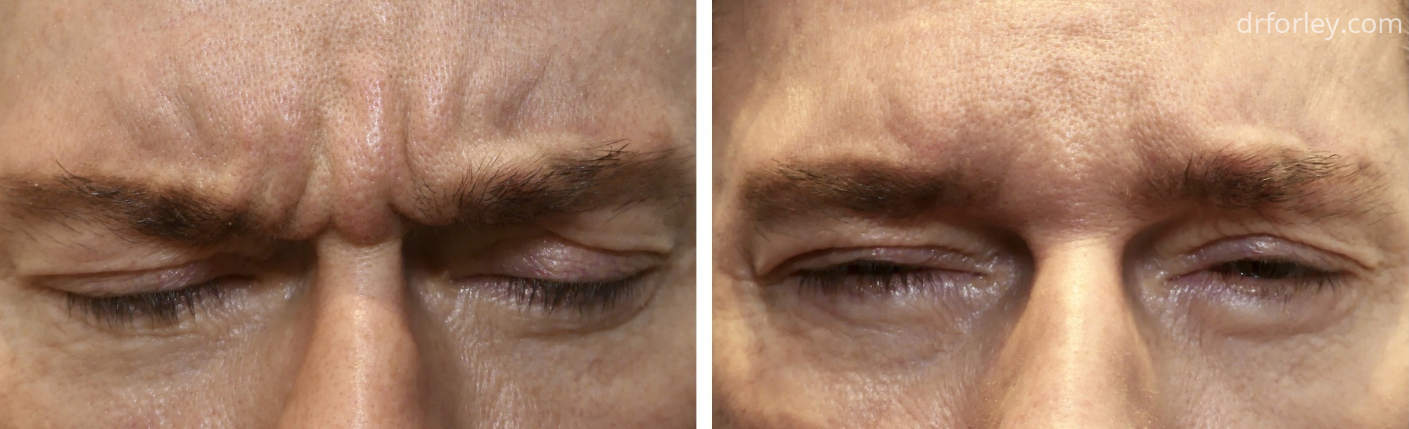 Male face, before and after BOTOX treatment, front view, patient 10