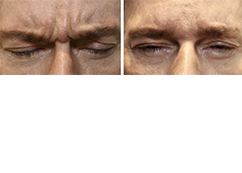 Male forehead, before and after Neuromodulator treatment, front view - patient 4