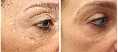 Blog - TREATMENT OF PERIORBITAL VEINS Photo Woman's face, 45 year old female 4 months following laser treatment of prominent periorbital vein, under eye