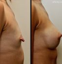 Woman's brest, Before and After breast-lift treatment photos, side view, patient 1