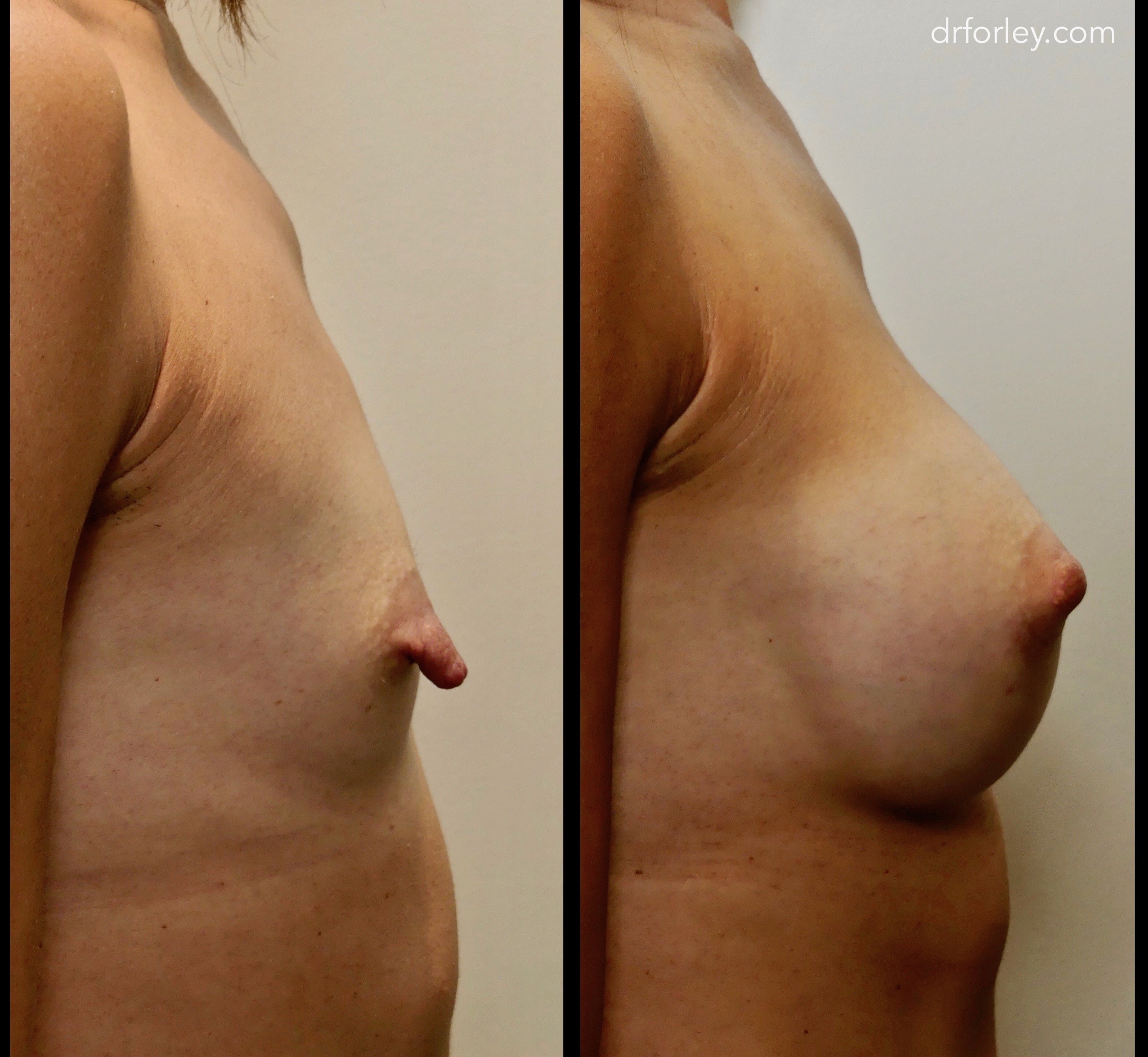 Blog - NIPPLE REDUCTION Photo Woman's brest, Before and After breast-lift treatment photos, side view, patient 1