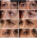 LOWER EYELID REJUVENATION - B/A photos