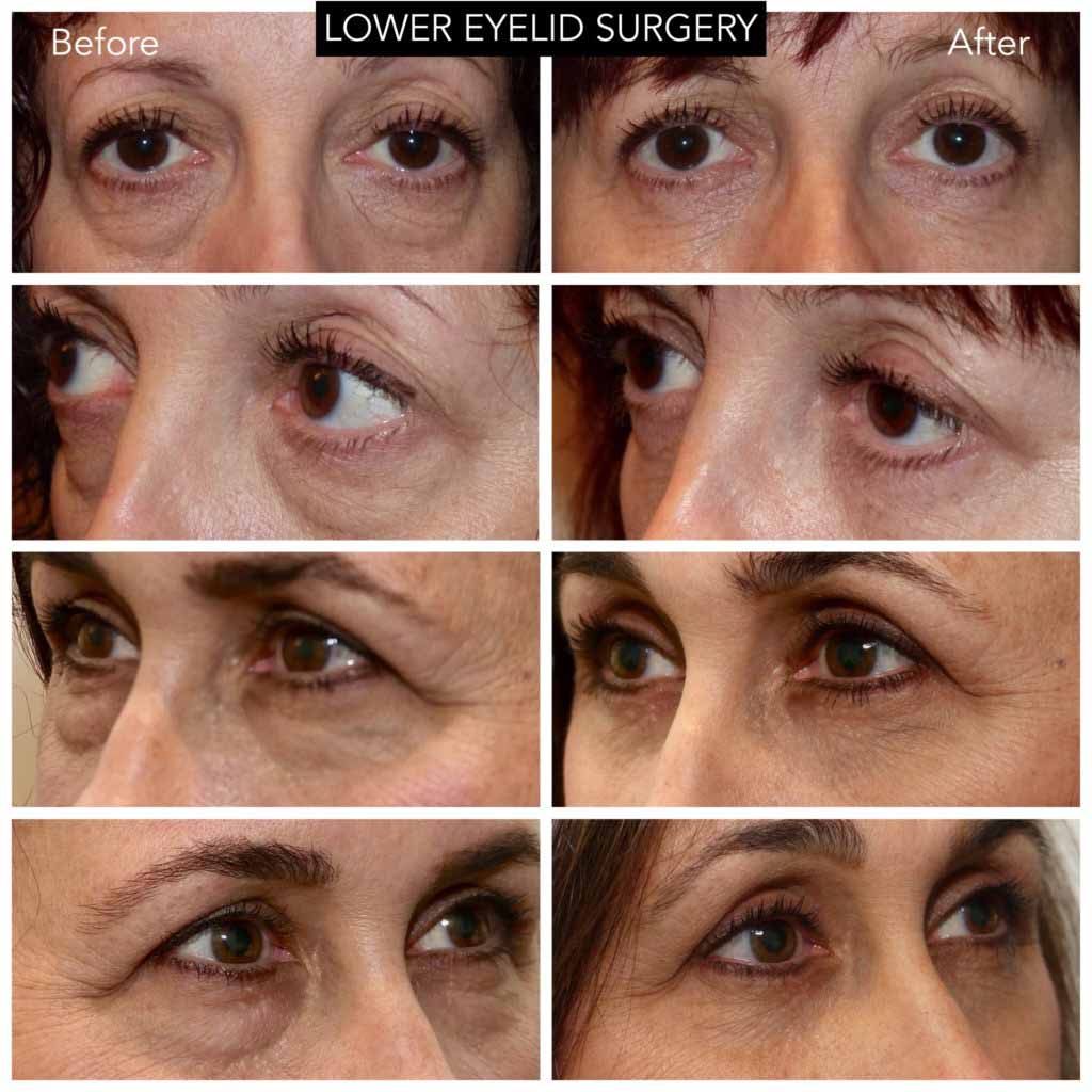 Blog - LOWER EYELID REJUVENATION Photo LOWER EYELID REJUVENATION - B/A photos