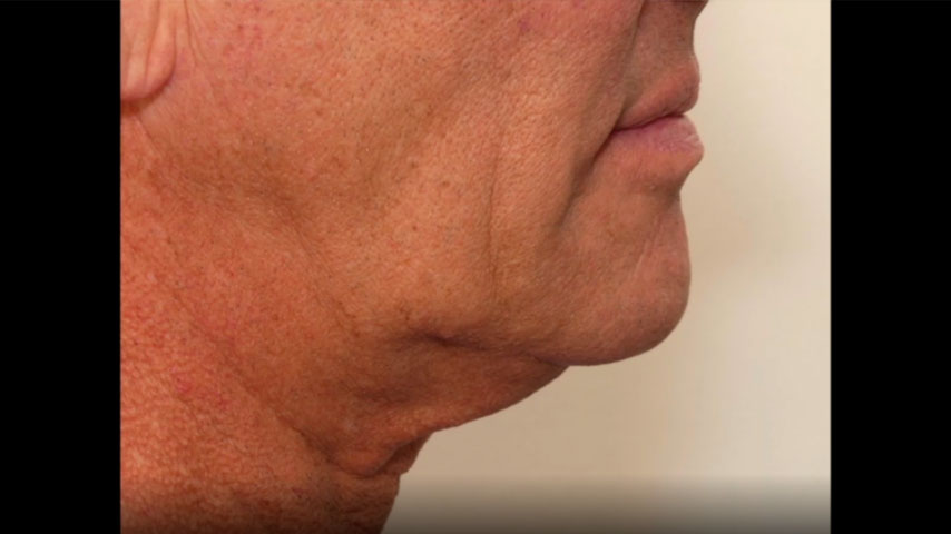 Male face, 61 year old male 6 months following FaceTite (side view)