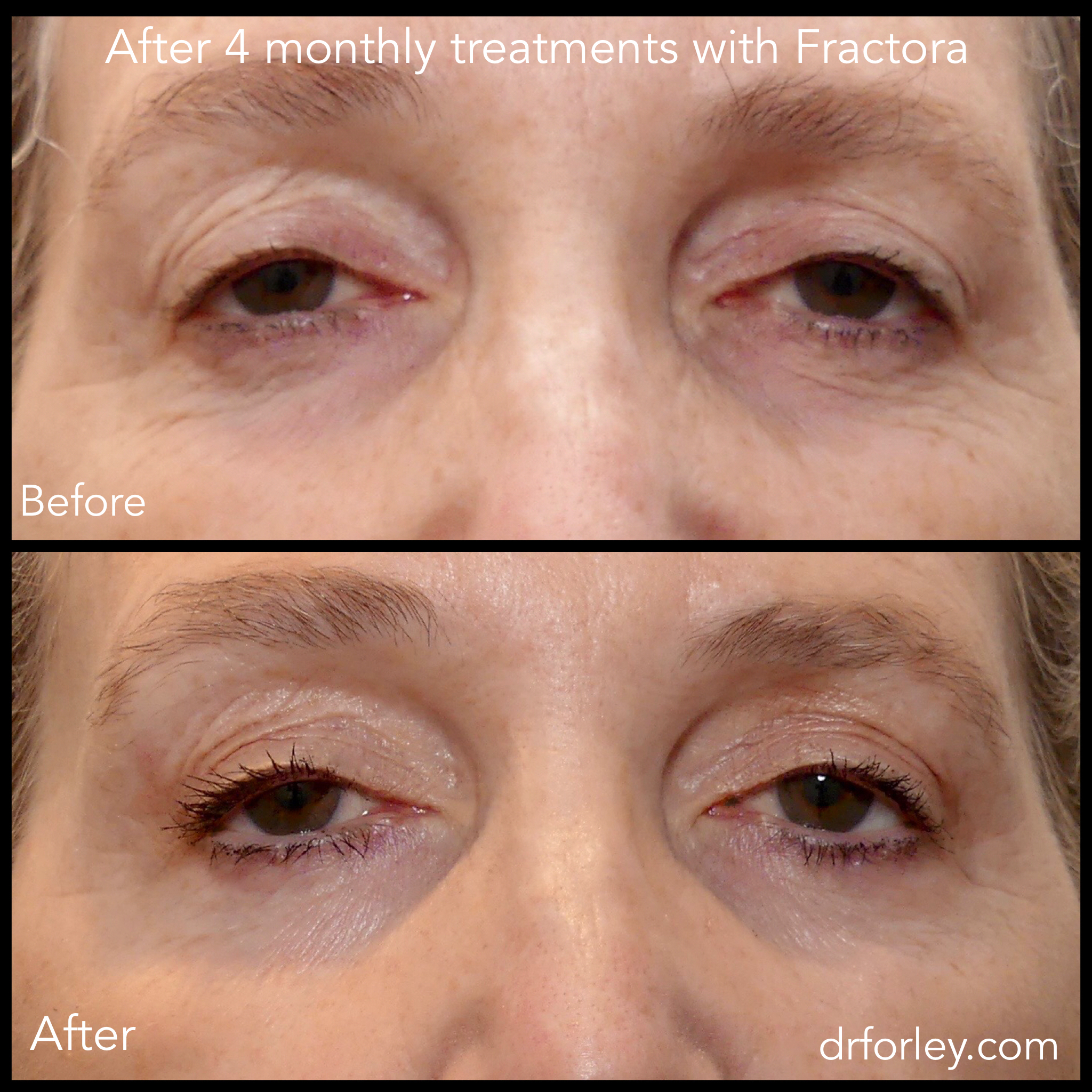 Blog - FRACTORA Photo Woman's face, before and after 4 monthly treatments with Fractora (front view)