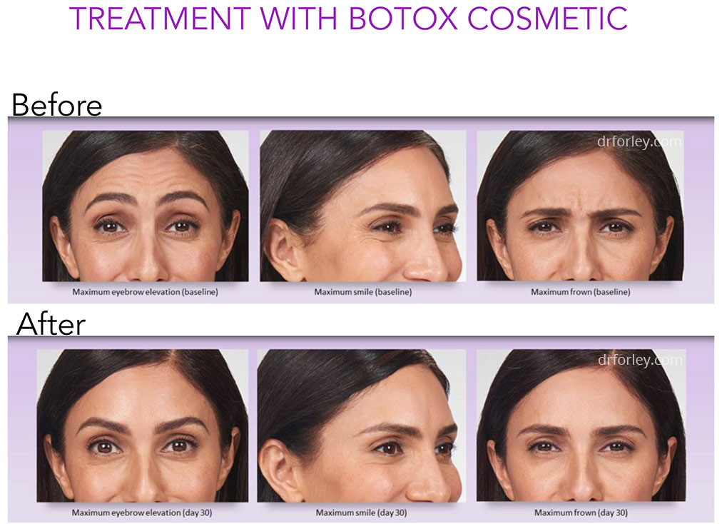 Treatment with Botox Cosmetic - Female face, before and after neuromodulators procedure