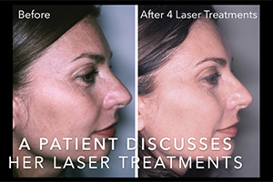 Watch Video: A FEMALE PATIENT DISCUSSES HER LASER EXPERIENCE | Dr. Forley