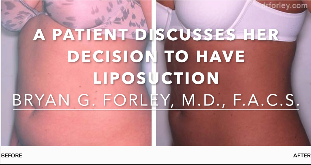 Watch Video: 30 year old patient of Dr. Forley discusses her liposuction procedure