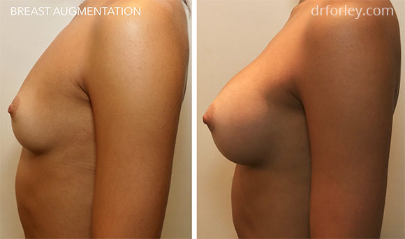 Female breast, before and after BREAST AUGMENTATION treatment photo, left side view, patient 1