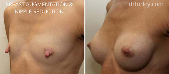 Female breast, before and after BREAST AUGMENTATION treatment photo, left side oblique view, patient 2