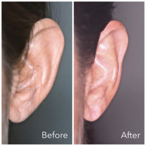Blog - Otoplasty for Prominent Ears Photo 