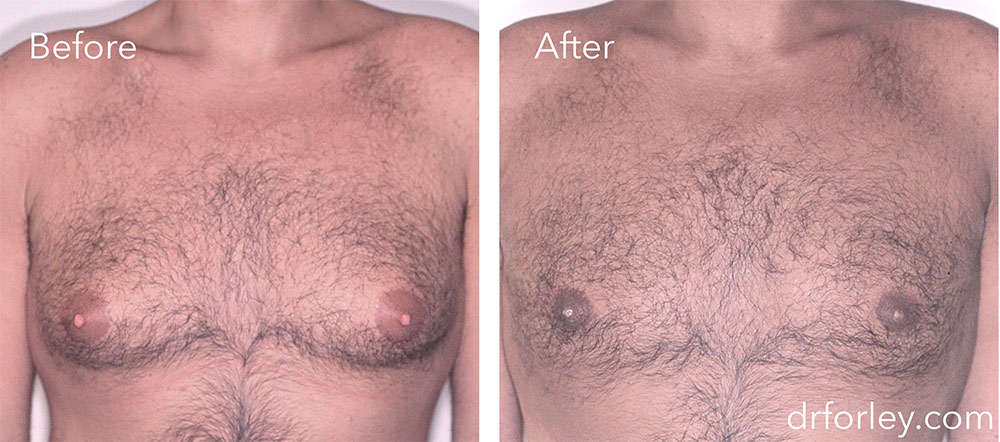 B/A photos: 36 year old male 8 months following gynecomastia surgery of the chest - front view