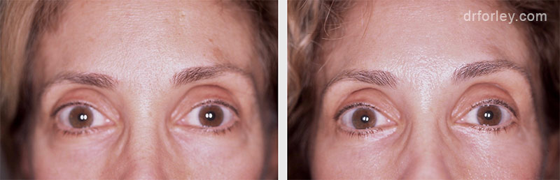 Before & After Eyes Set7 thumb7
