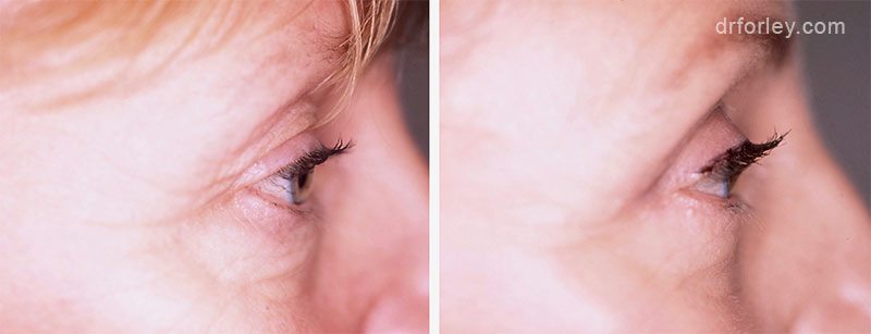 Female face, before and after Eyelid Surgery treatment, r-side view, patient 9