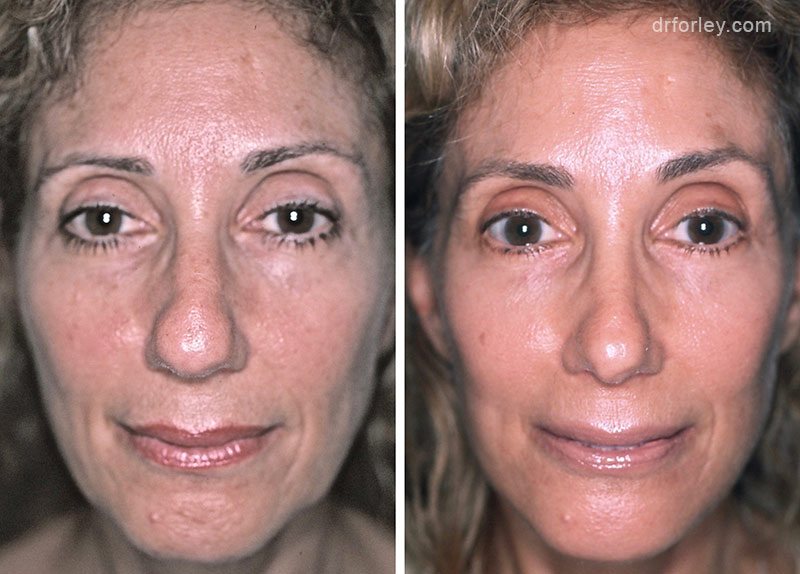 Female face, before and after Facelift treatment, front view