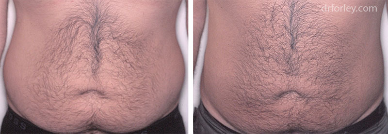 Male stomach, before and after liposuction treatment, front view, patient 3