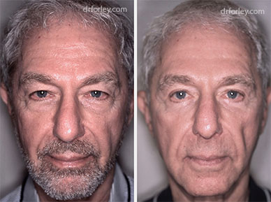 Male face, before & after Plastic Surgery treatment photo, front view, patient 1