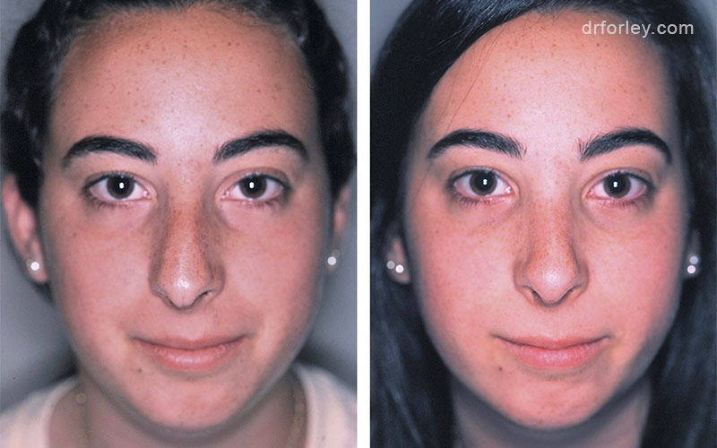 Female face, before and after rhinoplasty, front view, patient 6