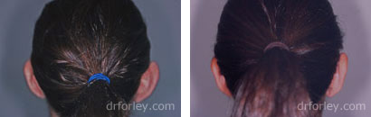 Before and After Otoplasty - Photo 1