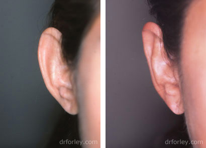 Before and After Otoplasty  - Photo 3