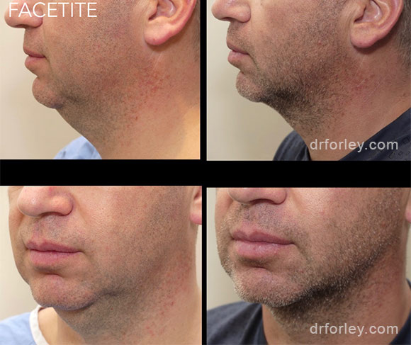 Male face, before & after FACETITE treatment  photo, side view, patient 1