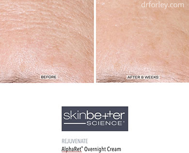 B/A photos - Skin Care Program: Skinbetter science AlphaRet Overnight Cream - Patient forehead, oblique view