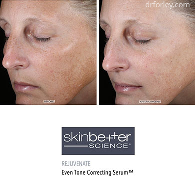 B/A photos - Skin Care Program: Skinbetter science Even Tone Correcting Serum - Woman's face, oblique view