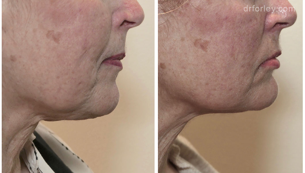 Female face, before and after Evoke treatment, side view, patient 7