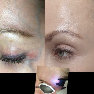 Blog - NORDLYS Nd:YAG LASER VEIN TREATMENT Photo 