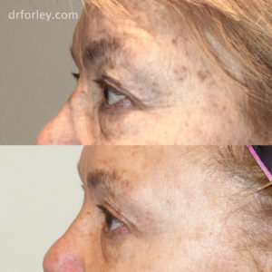 Blog - FACIAL AGE SPOTS Photo 